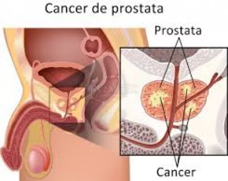 Cancerul care se extinde dincolo de tesutul prostatic nu poate fi vindecat