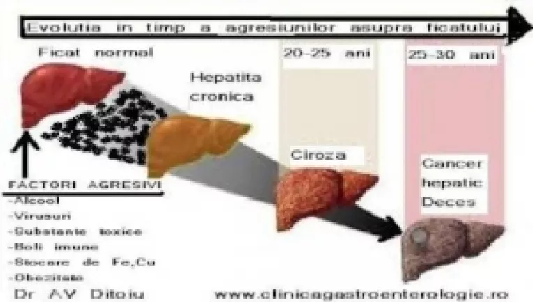 In Romania, in fiecare an mor 10.000 de oameni din cauza cirozei hepatice
