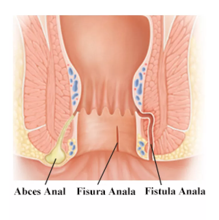 Sangerarea rectala poate fi data de multe afectiuni gastrointestinale