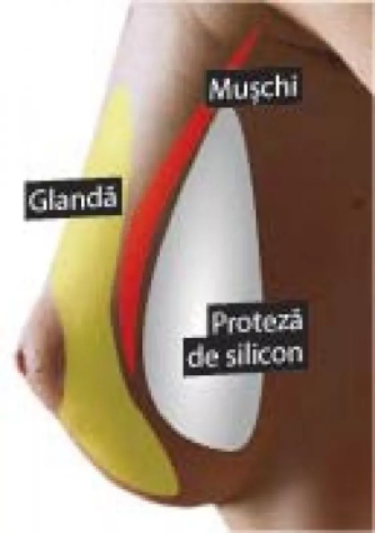 Scandalul silicoanelor PIP